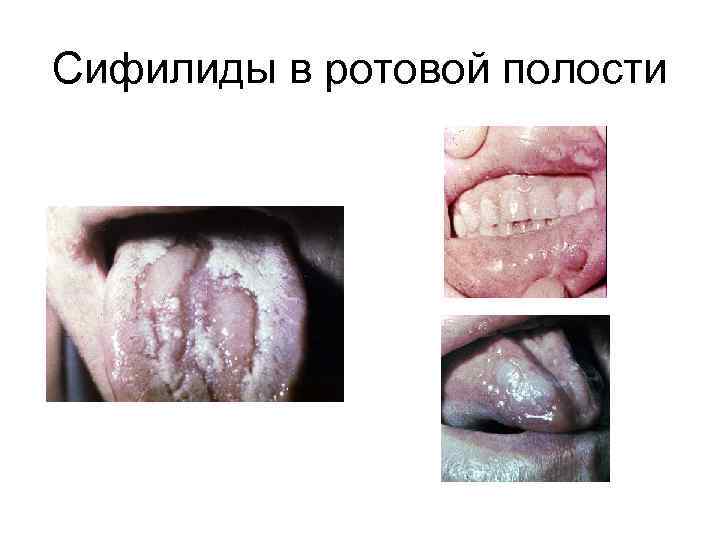 Сифилиды в ротовой полости 