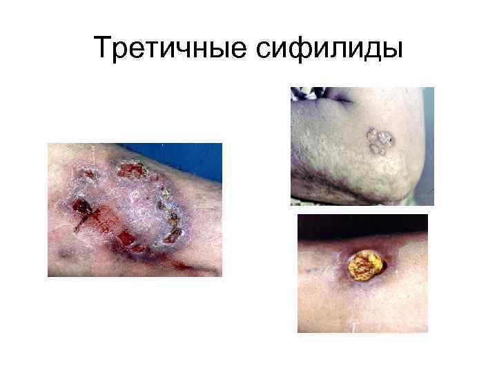 Третичные сифилиды 