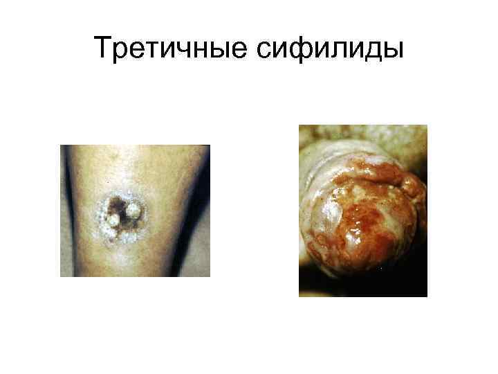 Третичные сифилиды 
