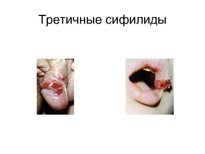 Третичные сифилиды 