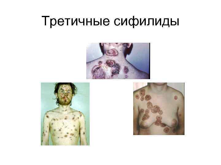 Третичные сифилиды 