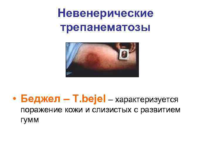    Невенерические   трепанематозы • Беджел – T. bejel – характеризуется