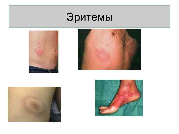 Эритемы 