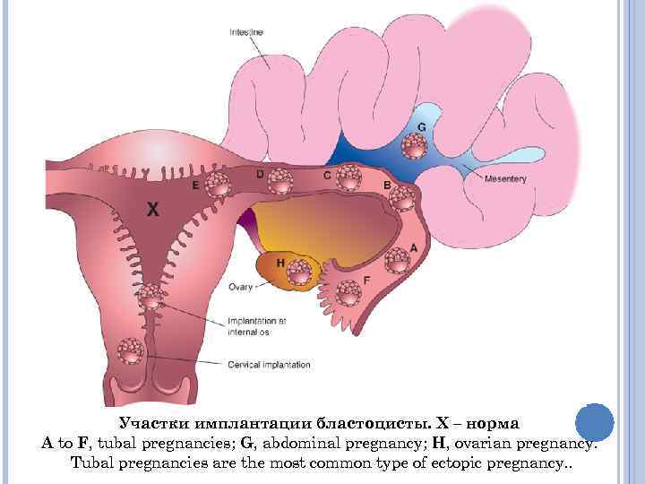   Участки имплантации бластоцисты. Х – норма A to F, tubal pregnancies; G,