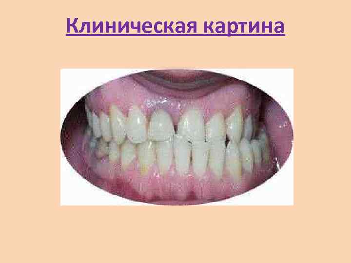 Клиническая картина 