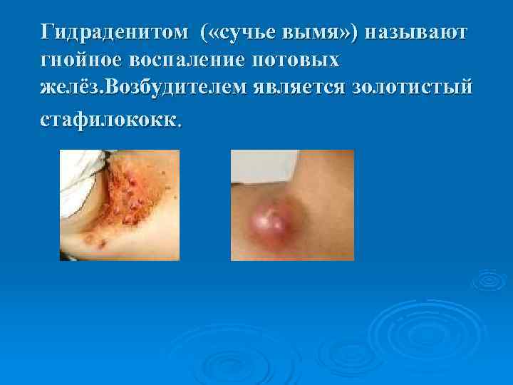 Гидраденитом ( «сучье вымя» ) называют гнойное воспаление потовых желёз. Возбудителем является золотистый стафилококк.