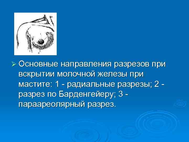 Ø Основные направления разрезов при  вскрытии молочной железы при  мастите: 1 -
