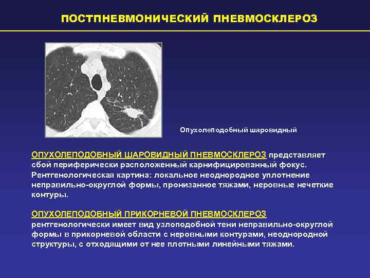  ПОСТПНЕВМОНИЧЕСКИЙ ПНЕВМОСКЛЕРОЗ       Опухолеподобный шаровидный  ОПУХОЛЕПОДОБНЫЙ ШАРОВИДНЫЙ