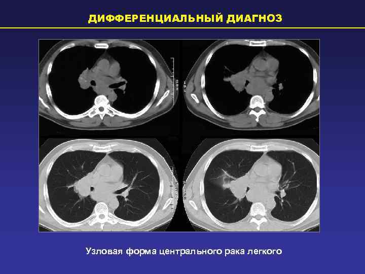 ДИФФЕРЕНЦИАЛЬНЫЙ ДИАГНОЗ Узловая форма центрального рака легкого 