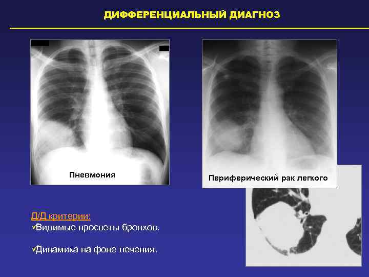    ДИФФЕРЕНЦИАЛЬНЫЙ ДИАГНОЗ  Пневмония   Периферический рак легкого  Д/Д