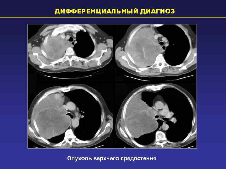 ДИФФЕРЕНЦИАЛЬНЫЙ ДИАГНОЗ  Опухоль верхнего средостения 