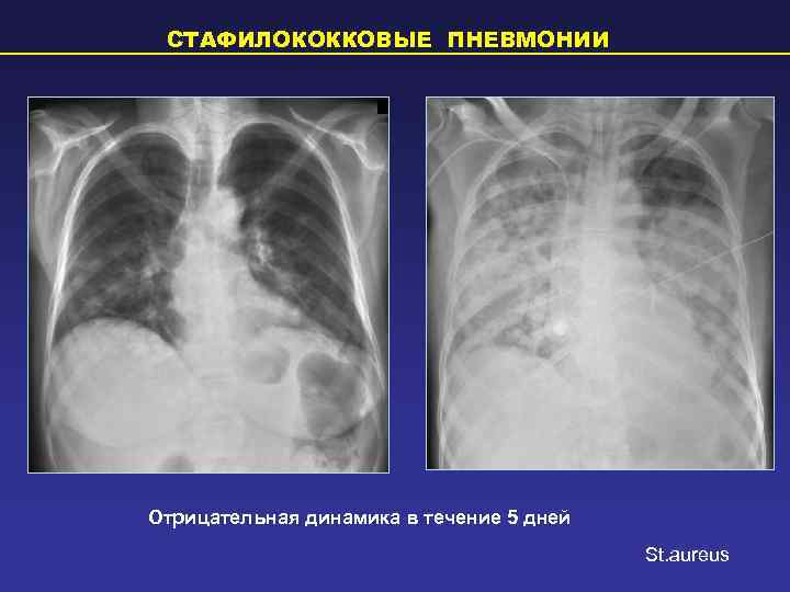  СТАФИЛОКОККОВЫЕ ПНЕВМОНИИ Отрицательная динамика в течение 5 дней    St. aureus