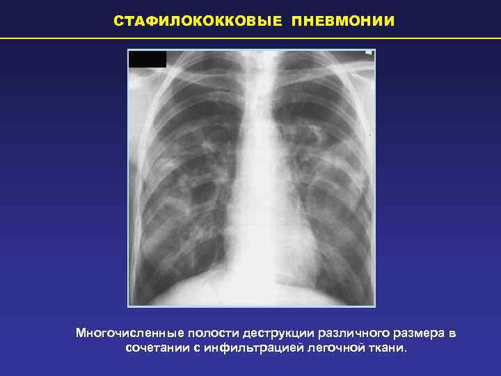  СТАФИЛОКОККОВЫЕ ПНЕВМОНИИ Многочисленные полости деструкции различного размера в  сочетании с инфильтрацией легочной
