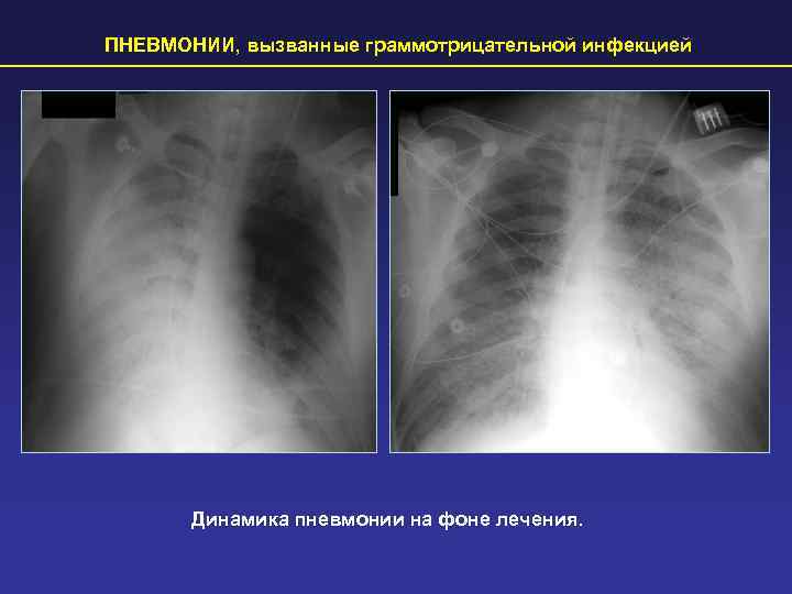 ПНЕВМОНИИ, вызванные граммотрицательной инфекцией  Динамика пневмонии на фоне лечения. 