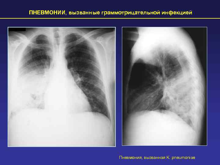 ПНЕВМОНИИ, вызванные граммотрицательной инфекцией      Пневмония, вызванная K. pneumoniae 