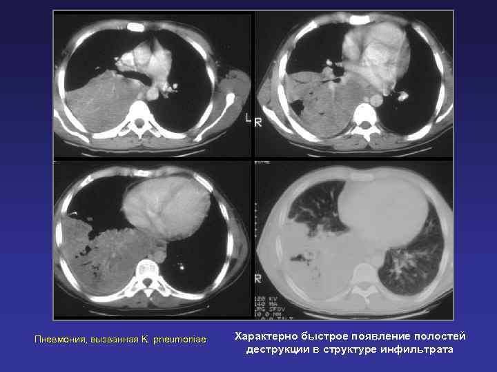 Пневмония, вызванная K. pneumoniae  Характерно быстрое появление полостей    деструкции в