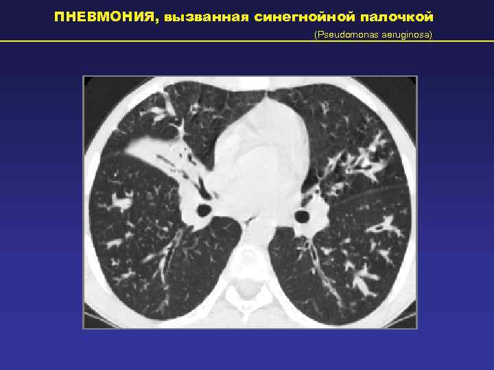 ПНЕВМОНИЯ, вызванная синегнойной палочкой     (Pseudomonas aeruginosa) 