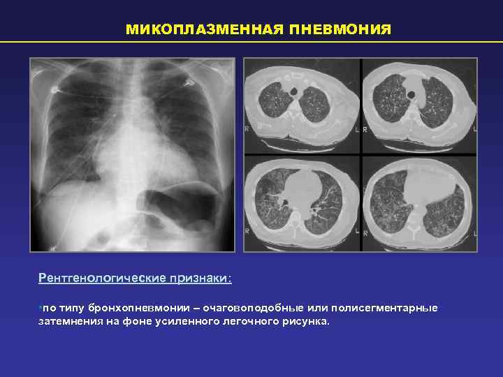    МИКОПЛАЗМЕННАЯ ПНЕВМОНИЯ Рентгенологические признаки:  • по типу бронхопневмонии – очаговоподобные