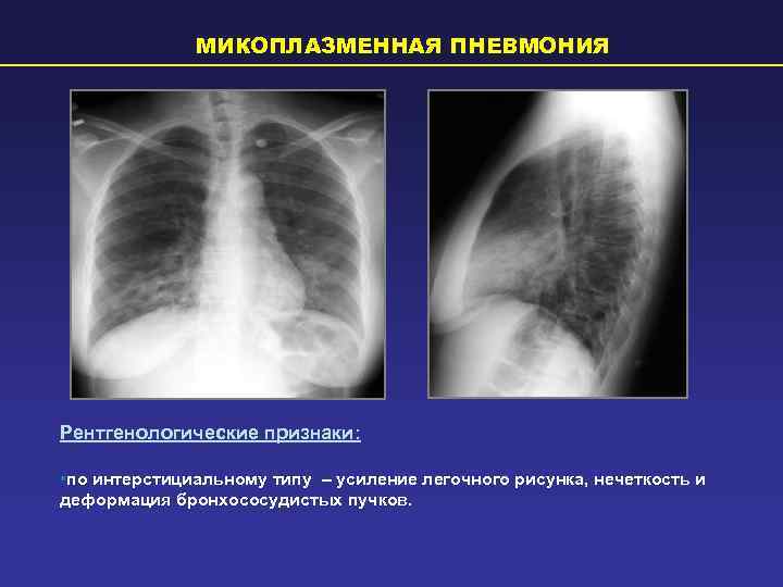    МИКОПЛАЗМЕННАЯ ПНЕВМОНИЯ Рентгенологические признаки:  • по интерстициальному типу – усиление
