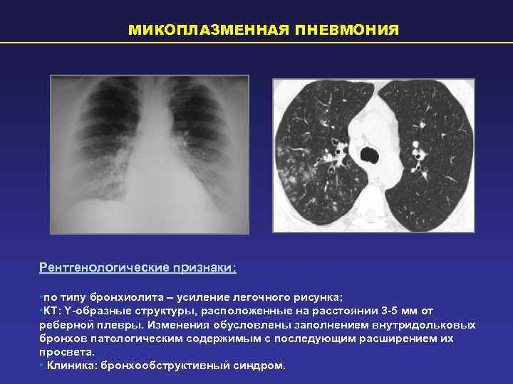    МИКОПЛАЗМЕННАЯ ПНЕВМОНИЯ Рентгенологические признаки:  • по типу бронхиолита – усиление