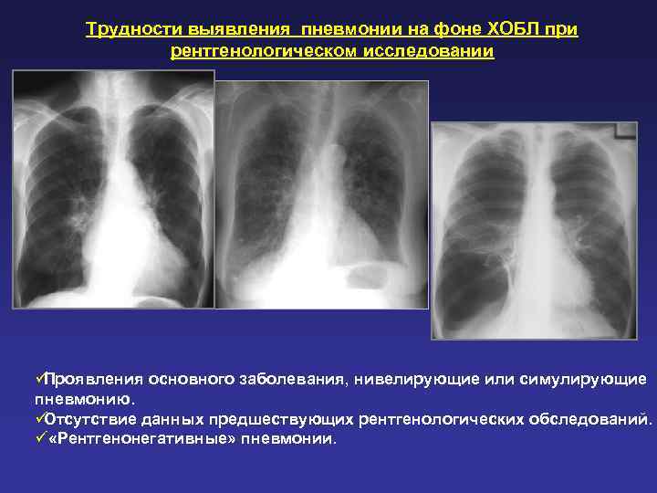  Трудности выявления пневмонии на фоне ХОБЛ при   рентгенологическом исследовании üПроявления основного