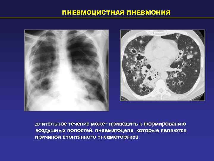   ПНЕВМОЦИСТНАЯ ПНЕВМОНИЯ длительное течение может приводить к формированию воздушных полостей, пневматоцеле, которые