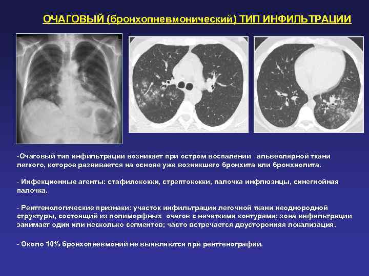  ОЧАГОВЫЙ (бронхопневмонический) ТИП ИНФИЛЬТРАЦИИ -Очаговый тип инфильтрации возникает при остром воспалении альвеолярной ткани