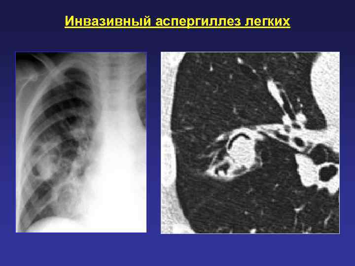 Инвазивный аспергиллез легких 