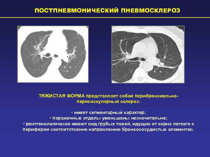   ПОСТПНЕВМОНИЧЕСКИЙ ПНЕВМОСКЛЕРОЗ  ТЯЖИСТАЯ ФОРМА представляет собой перибронхиально-    периваскулярный