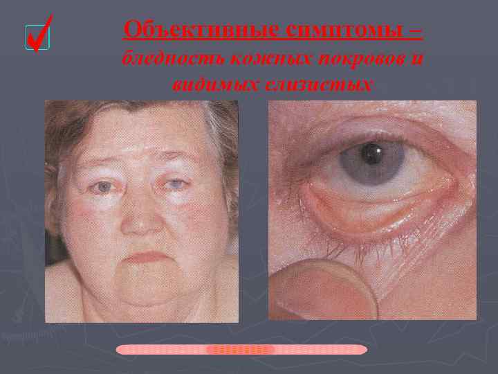 Объективные симптомы – бледность кожных покровов и видимых слизистых 