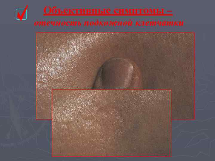  Объективные симптомы – отечность подкожной клетчатки 