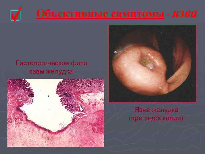  Объективные симптомы - язва  Гистологическое фото язвы желудка    