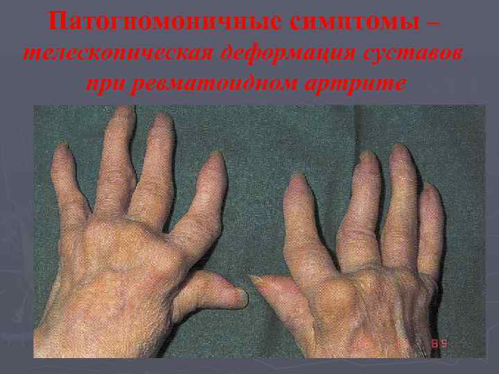  Патогномоничные симптомы – телескопическая деформация суставов при ревматоидном артрите 