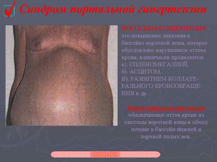 Синдром портальной гипертензии   ПОРТАЛЬНАЯ ГИПЕРТЕНЗИЯ -   это повышение давления в