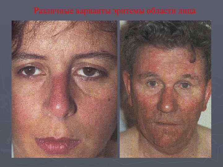 Различные варианты эритемы области лица 