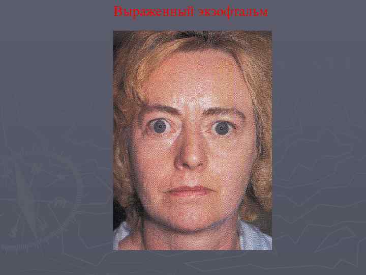 Выраженный экзофтальм 