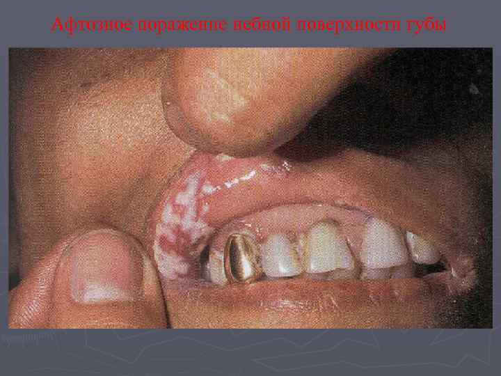 Афтозное поражение небной поверхности губы 