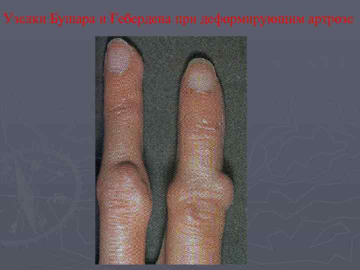 Узелки Бушара и Гебердена при деформирующим артрозе 