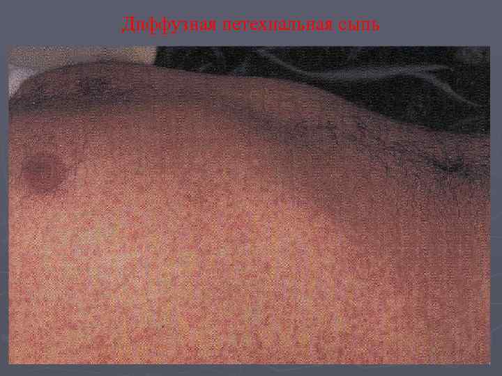 Диффузная петехиальная сыпь 