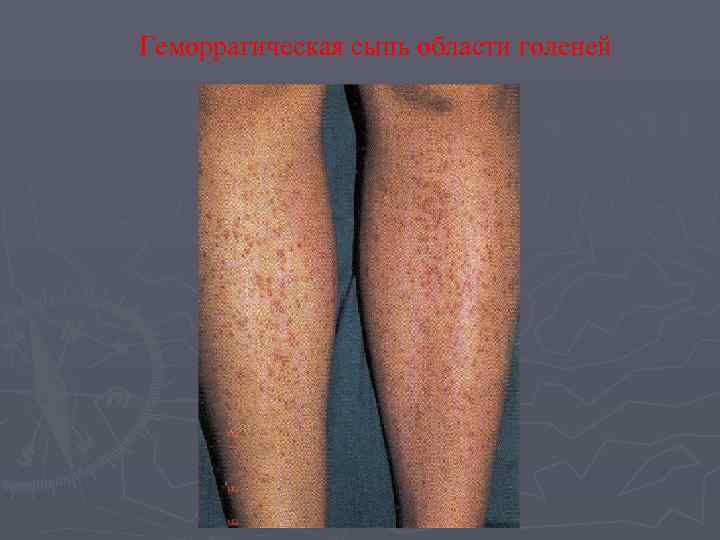 Геморрагическая сыпь области голеней 