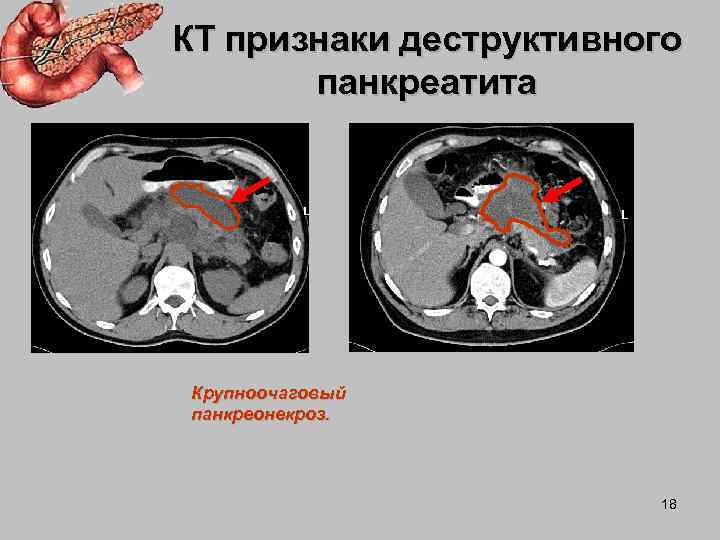 Кт картина острого панкреатита