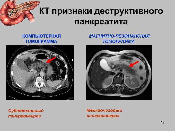 Кт признаки. Острый панкреатит компьютерная томография. Кт картина острого панкреатита. Некротизирующий панкреатит кт.