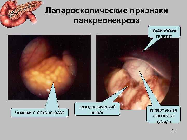   Лапароскопические признаки    панкреонекроза      