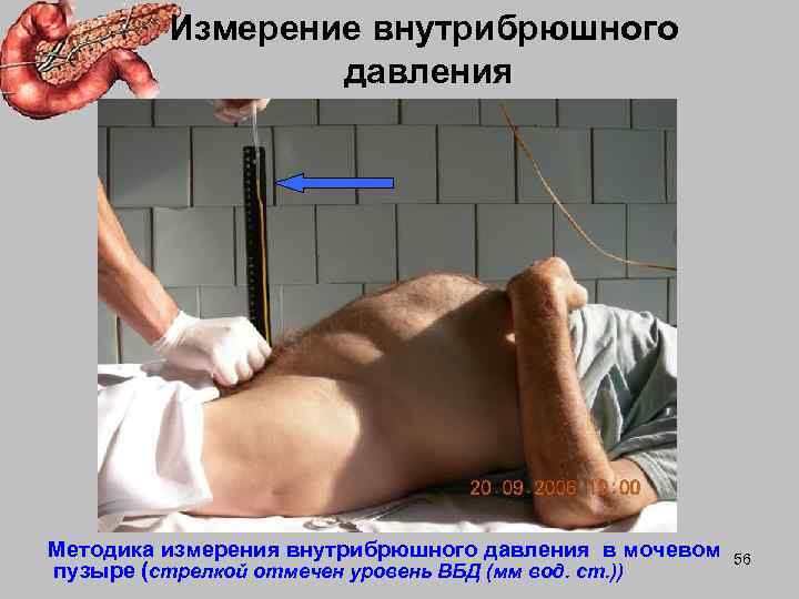    Измерение внутрибрюшного   давления Методика измерения внутрибрюшного давления в мочевом