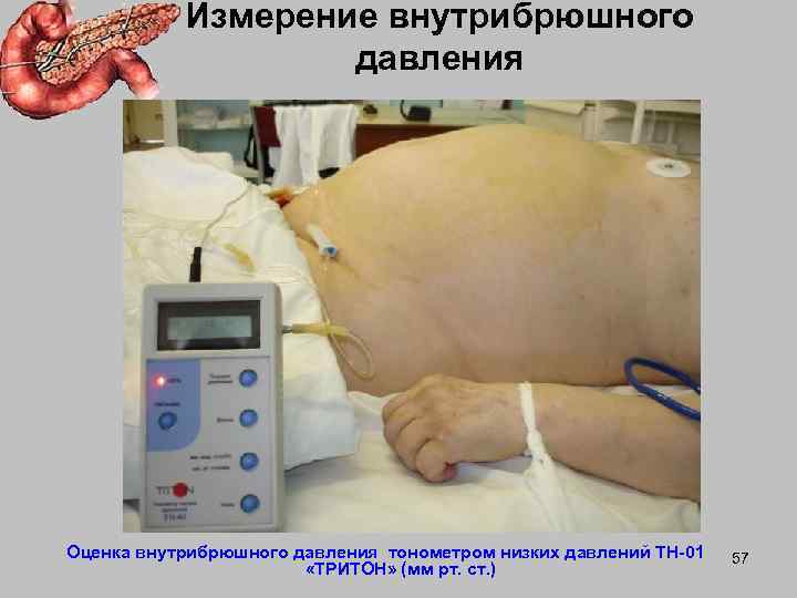   Измерение внутрибрюшного    давления Оценка внутрибрюшного давления тонометром низких давлений