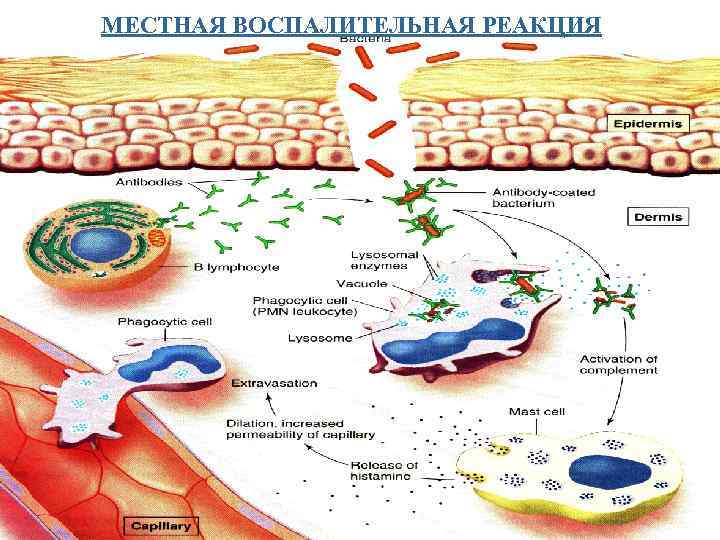 Местные воспаления. Местные воспалительные реакции. Местные реакции воспаления. Локальная воспалительная реакция. Местное воспалительная реакция cartoons.