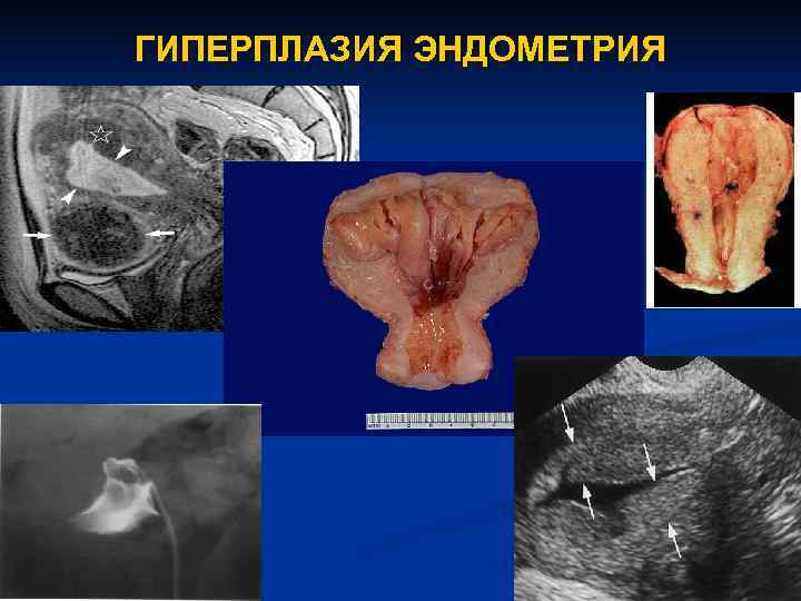 ГИПЕРПЛАЗИЯ ЭНДОМЕТРИЯ 