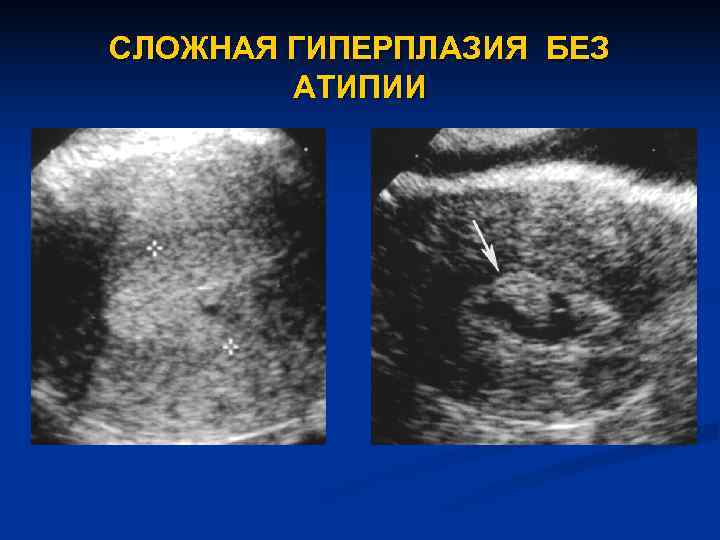 Удаление матки при гиперплазии. Очаговая гиперплазия эндометрия матки на УЗИ. Атипическая гиперплазия эндометрия УЗИ. Неатипическая гиперплазия эндометрия. Гиперплазия эндометрия с атипией гистология.