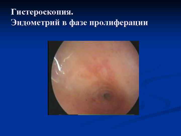 Гистероскопия.  Эндометрий в фазе пролиферации 