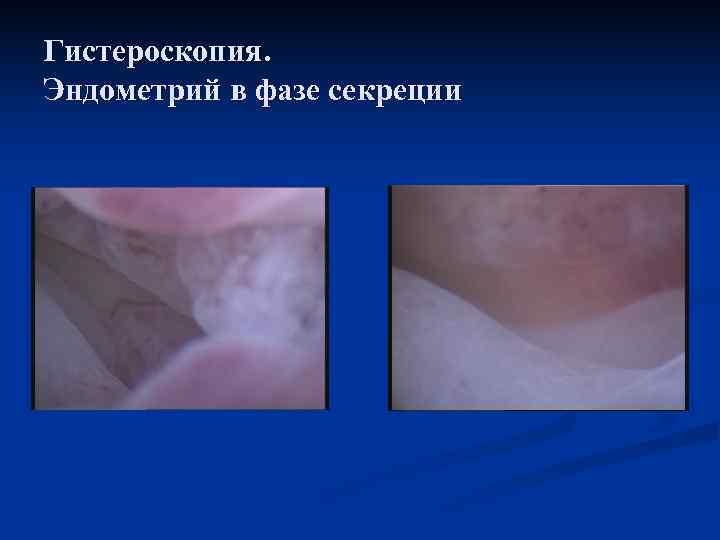 Гистероскопия.  Эндометрий в фазе секреции 